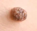 What Does Skin Cancer Look Like-skinhealthcancer