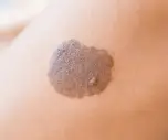 skin cancer pictures early stages-skinhealthcancer